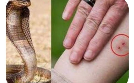 सर्पदंश से महिला की हालत बिगड़ी